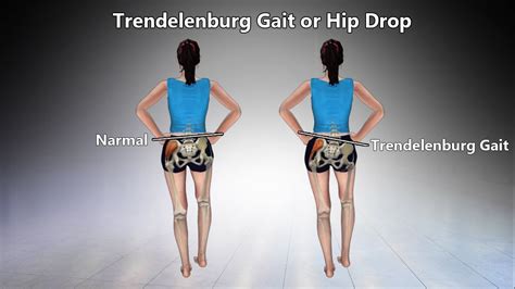 trendelenburg test vs hip drop test|how to correct trendelenburg gait.